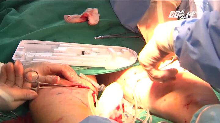 Kỹ thuật mới chữa bệnh giãn tĩnh mạch chân không cần mổ