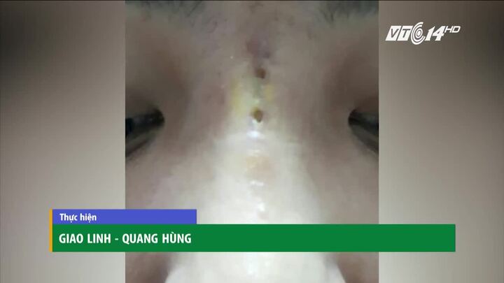 Nâng mũi bằng chỉ giá rẻ, nữ diễn viên bị thủng mũi