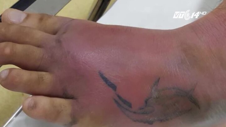 Nhiễm trùng huyết, chân mưng mủ vì xăm không an toàn