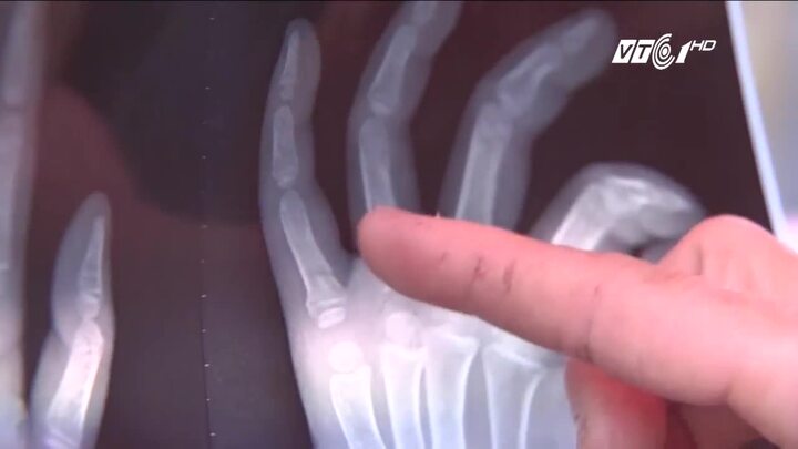 Cô giáo mầm non bị tố vụt gãy tay trẻ ở Nghệ An