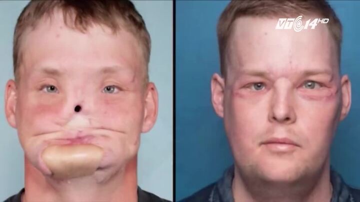 Góa phụ nén đau thương, hiến tặng khuôn mặt của người chồng quá cố