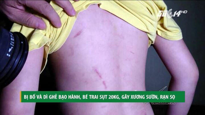Bị bạo hành đến gãy xương sườn, bé trai 10 tuổi vẫn xin mẹ: 'Đừng để bố vào tù'
