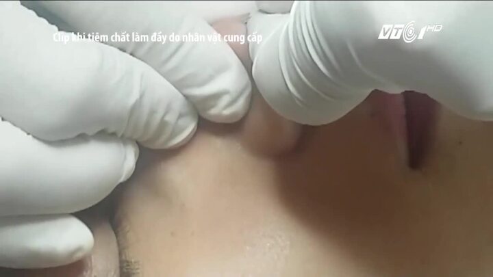 Mù mắt vì tiêm filler, thẩm mỹ viện nói nạn nhân do năm tuổi nên xui?