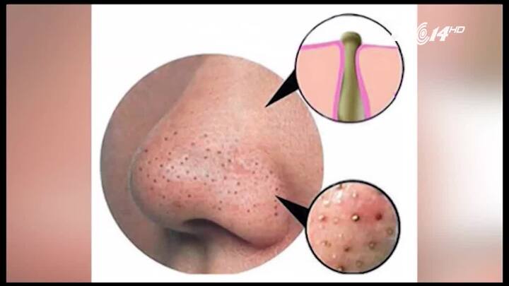 Để mẹ nặn mụn đầu đen, bé gái 10 tuổi suýt mất mạng