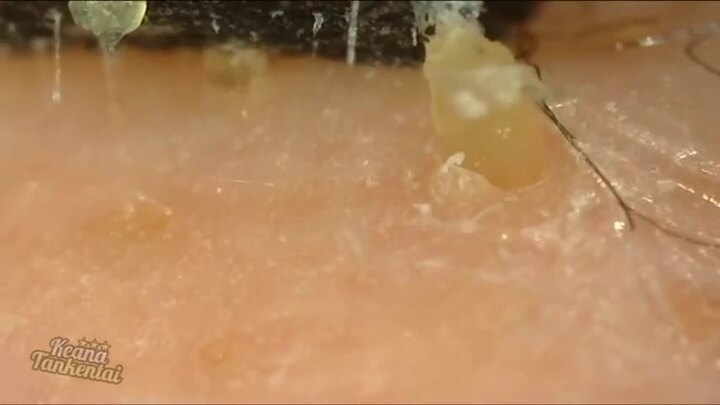 Video: Rút mụn đầu đen khỏi mũi, xem vừa thích vừa sợ