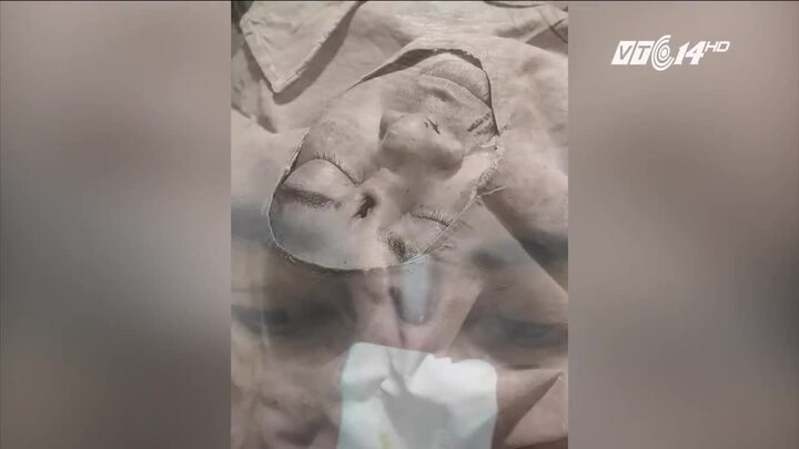 Nhìn hình ảnh này sẽ không còn ai dám tự ý đi phẫu thuật nâng mũi