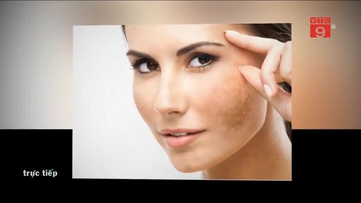 Cách trị nám, tàn nhang hiệu quả và an toàn