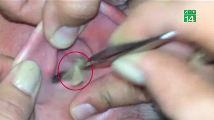TP.HCM: Bé gái ngủ trên sàn nhà bị rết chui vào tai