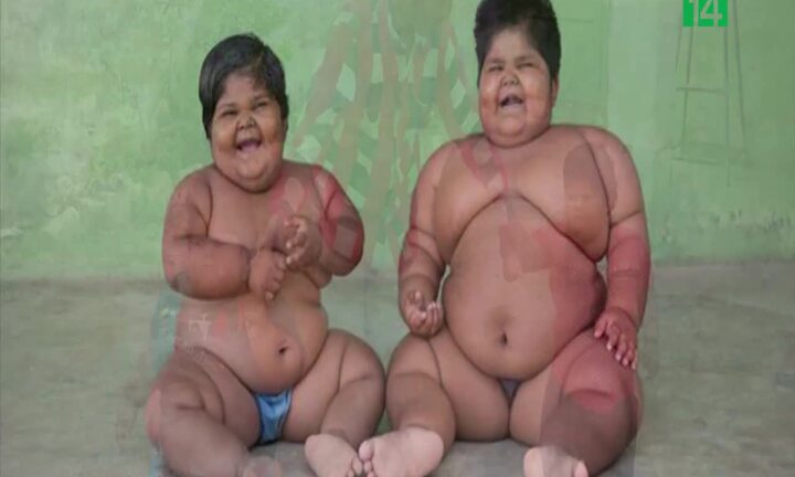 2 bé gái Ấn Độ phải cắt bớt dạ dày để giảm cân