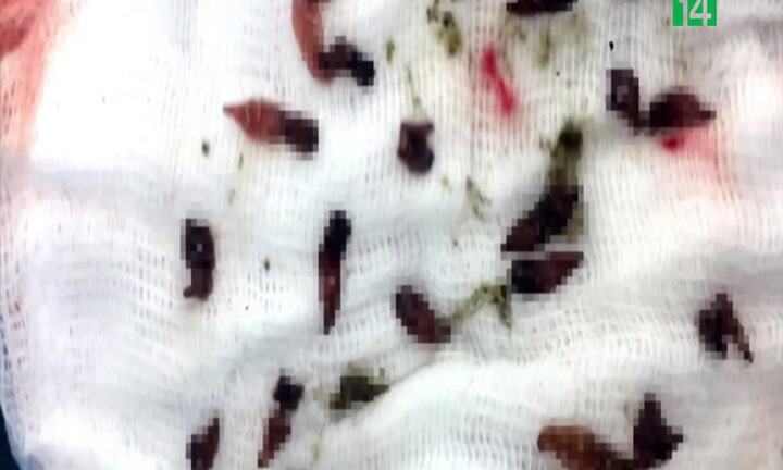 Đồng Nai: Gắp, hút 800 con sán lá gan trong ống mật người hay ăn gỏi cá