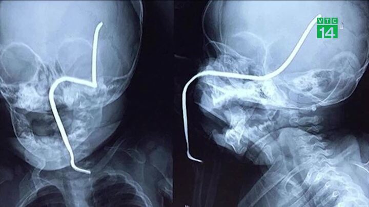 Chơi gần máy cắt cỏ, bé gái 8 tháng tuổi bị thanh sắt đâm xuyên má