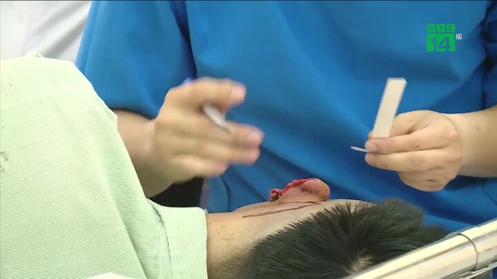 Cãi nhau khi uống rượu, nam thanh niên bị bạn nhậu cắn đứt tai