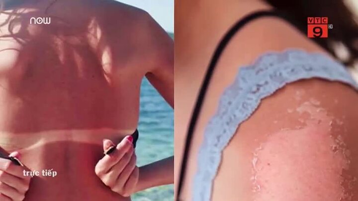 Phải làm sao khi da cháy nắng?