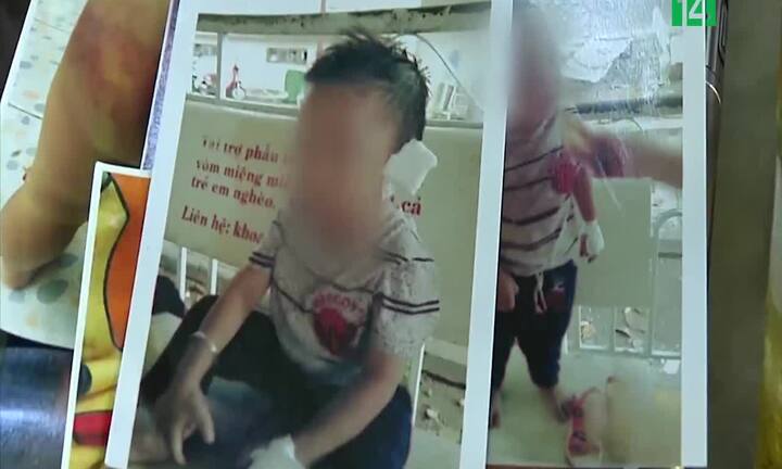 Nghi vấn bé trai 4 tuổi ở Bình Dương bị cha dượng bạo hành