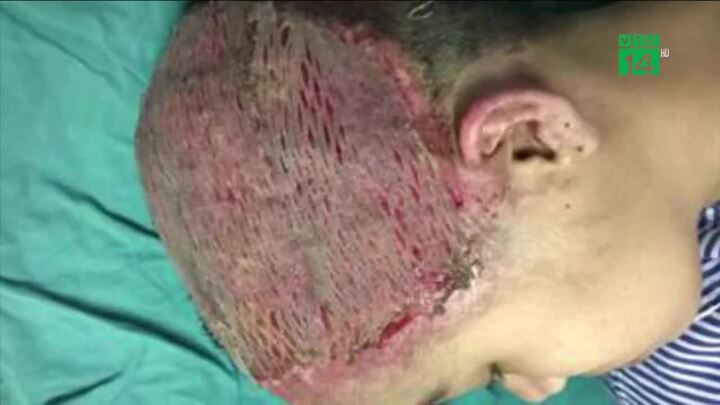 Clip: Uốn tóc mừng sinh nhật, cô gái 17 tuổi bị bỏng sâu toàn bộ da đầu