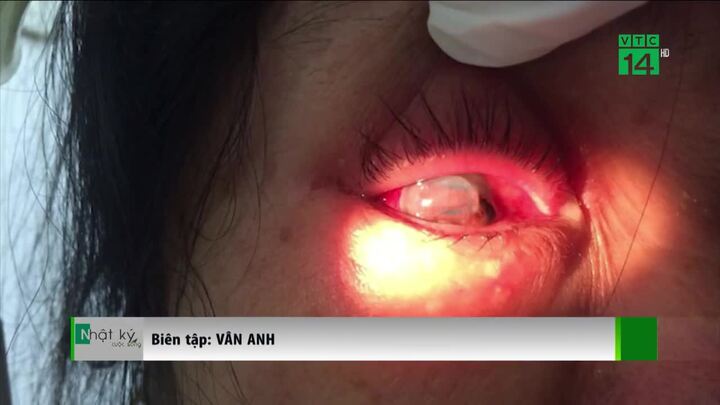 Bị chồng bạo hành đến vỡ nhãn cầu