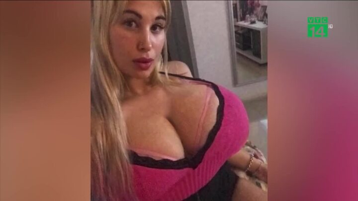 Cô gái phẫu thuật để có vòng ngực hơn 1 mét