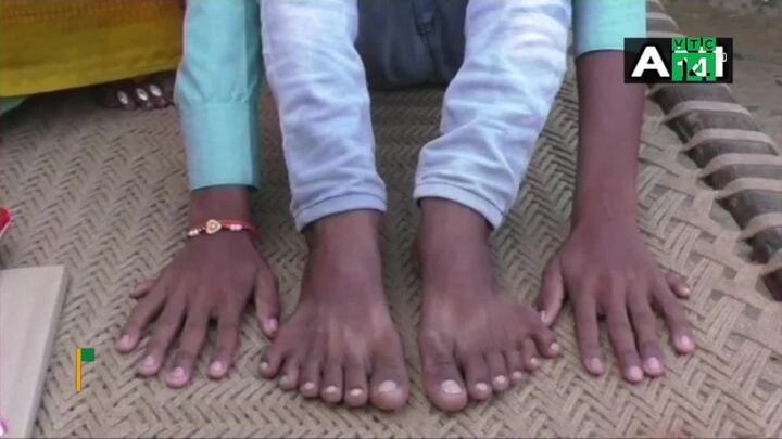 Bé trai có 12 ngón tay, 12 ngón chân bị người thân đòi hiến tế