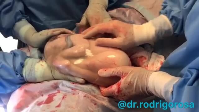 Rung động với khoảnh khắc em bé cuộn mình ngủ say trong túi ối