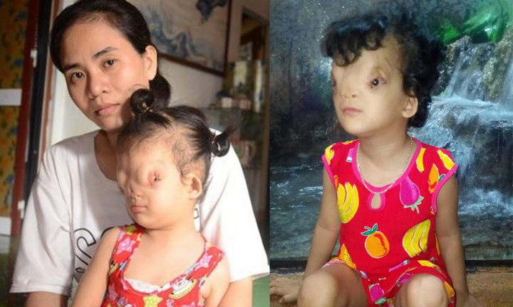 Tìm lại gương mặt cho cô bé mang dị tật hiếm gặp ở Quảng Bình