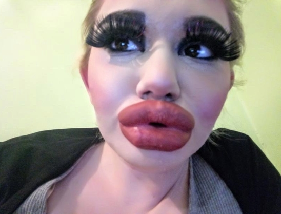 Cô gái trẻ điên cuồng tiêm môi 17 lần để sở hữu đôi môi lớn nhất thế giới