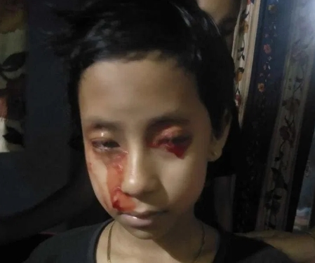 Bệnh lạ khiến bé gái 8 tuổi 'khóc' ra máu