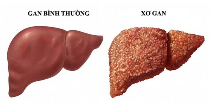 Uống rượu xong có 4 biểu hiện này bạn cần đi khám xơ gan ngay