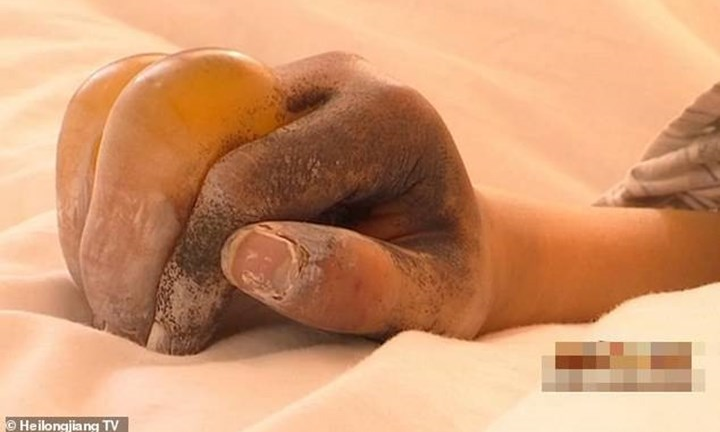 Video: Bàn tay nữ sinh biến dạng, chuyển màu đen sau ba giờ dọn tuyết ở trường