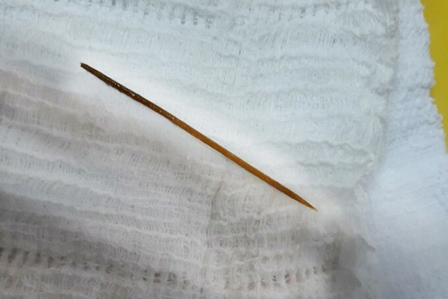 Nuốt tăm tre dài 5cm, cụ ông 72 tuổi bị thủng ruột