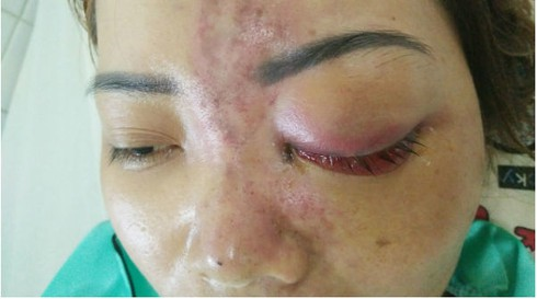Video: Tiêm filler nâng mũi giá 1,5 triệu đồng, nữ sinh 15 tuổi mù mắt