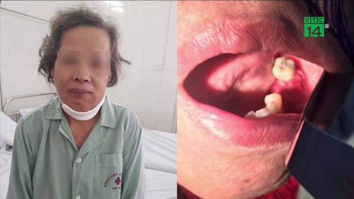 Tưởng sâu răng, người phụ nữ phải cắt hàm vì mắc bệnh nguy hiểm