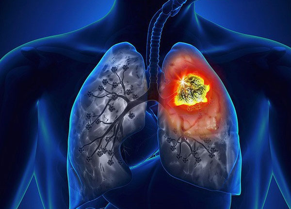 Dấu hiệu nhận biết bệnh viêm phổi cấp