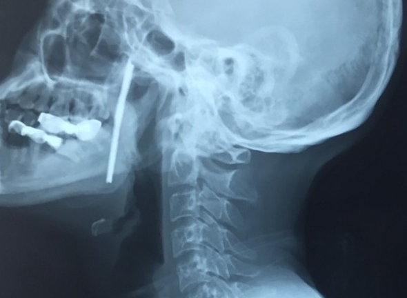 Cứu người đàn ông bị thanh sắt đâm xuyên cổ