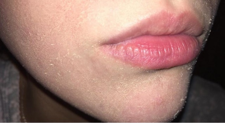 7 dấu hiệu cho thấy bạn đang bị thiếu vitamin A