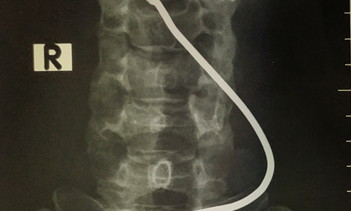 Nổ lốp xe tải, người đàn ông bị thanh sắt bắn vào cổ