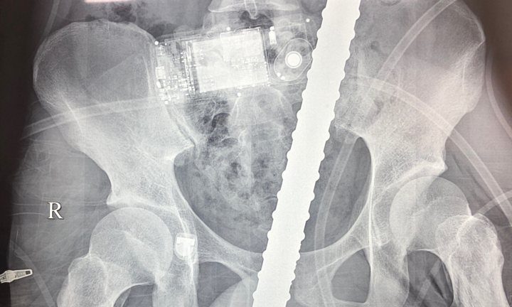 Cứu sống thanh niên bị 2 thanh sắt đâm xuyên ngực nguy kịch