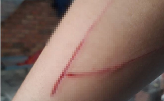 Thông tin bất ngờ liên quan vết rạch trên tay bé gái 15 tuổi bị hiếp dâm 