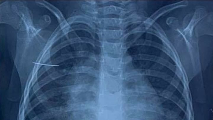 Kim khâu 4cm trong cơ thể bé gái 3 tuổi