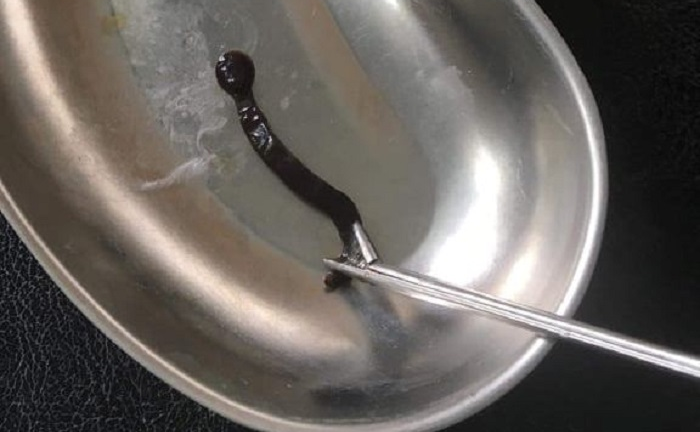 Con đỉa dài 4cm sống ký sinh cả tháng trời trong mũi bé gái 11 tuổi