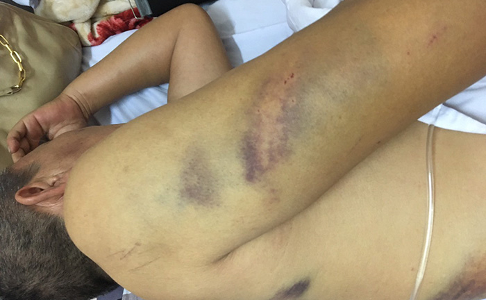 Thầy giáo dạy lái xe ở Hải Dương bị 2 kẻ côn đồ đánh gãy 4 xương sườn