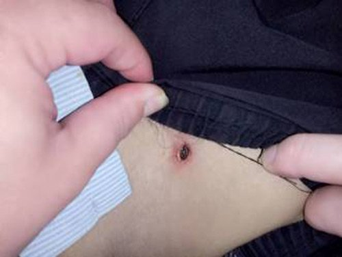 Bác sĩ cảnh báo nguy hiểm từ vết côn trùng đốt