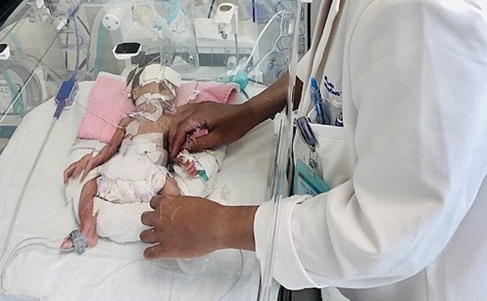 Bé nặng 1,2kg được phẫu thuật ruột thành công