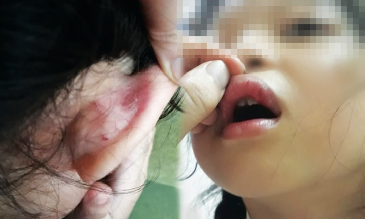 Cô giáo bị tố đánh học sinh bầm tím: Kết quả giám định pháp y ra sao?