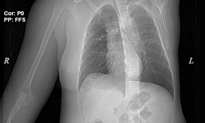 Đắp thuốc nam chữa ung thư vú, người phụ nữ bị lở loét một bên ngực