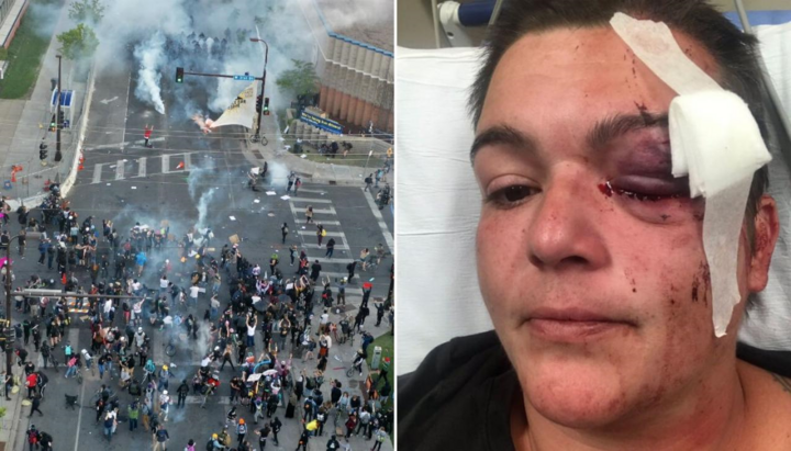 Đưa tin biểu tình Mỹ, nữ phóng viên trúng đạn, mù vĩnh viễn 1 mắt