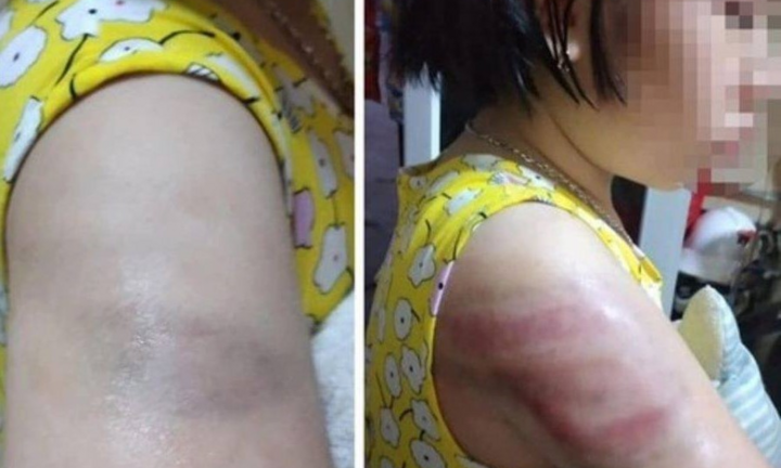 Đánh học sinh bầm tím tay, cô giáo bị đình chỉ hết năm học