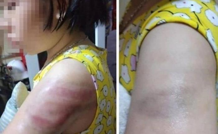 Cô giáo ở Nam Định đánh học sinh bầm tím tay: Bộ GD&ĐT nói gì?