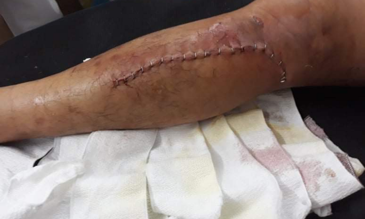 Kẻ đánh gãy chân hiệp sĩ bắt cướp ở Bình Dương đối diện mức án nào?