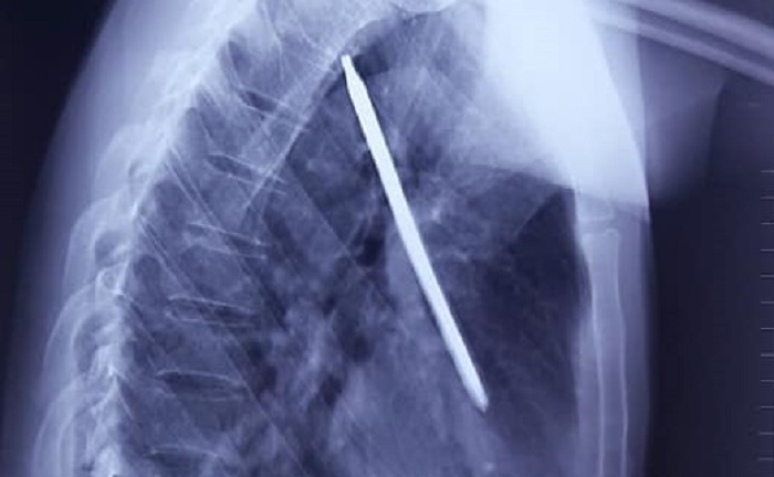 Cắt cỏ bằng máy, người đàn ông bị tuốc nơ vít cắm sâu vào phổi