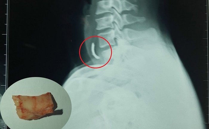 Hóc xương heo khi ăn bún, người đàn ông suýt chết 